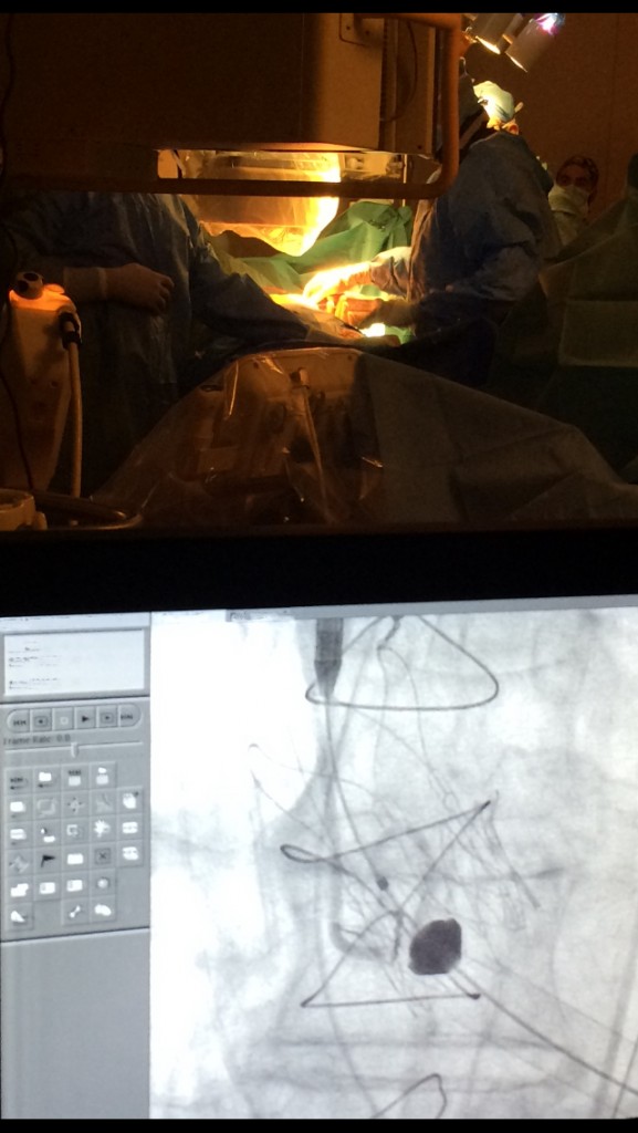TAVI 577x1024 - Πρωτοποριακή καρδιοχειρουργική επέμβαση από την "Ομάδα Καρδιάς" του Mediterraneo Hospital