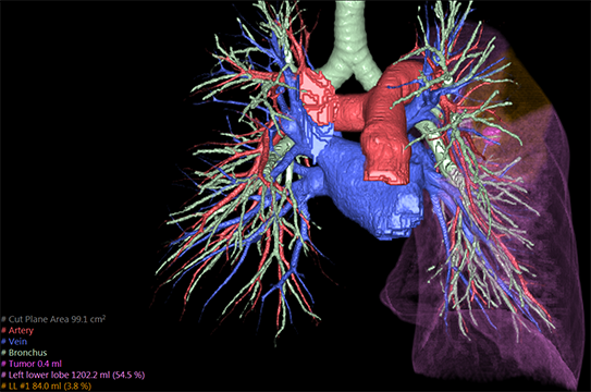 endo1 - SYNAPSE 3D για τον εντοπισμό όγκων του πνεύμονα!